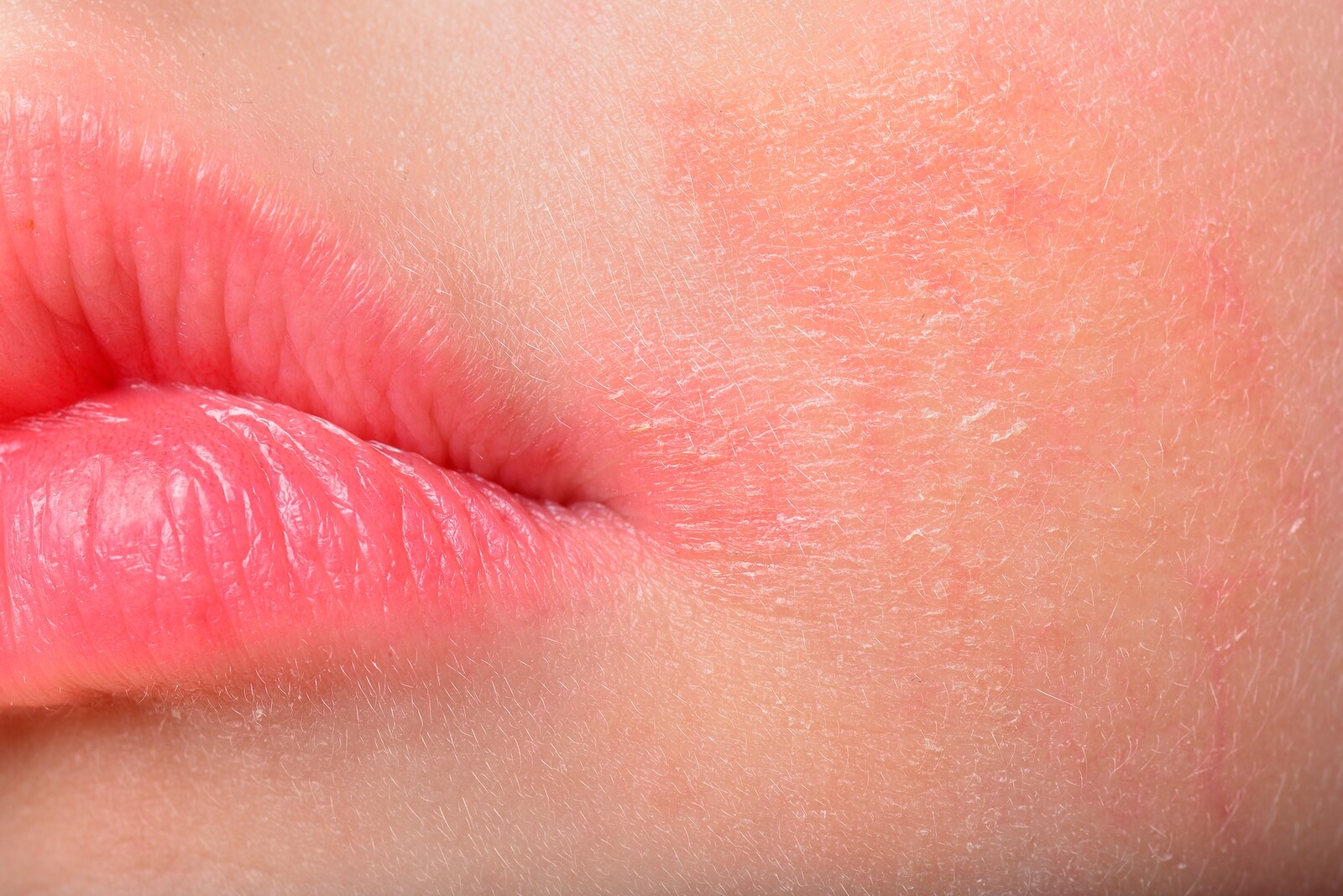 Visage et bouche d'un enfant atteint de dermatite.