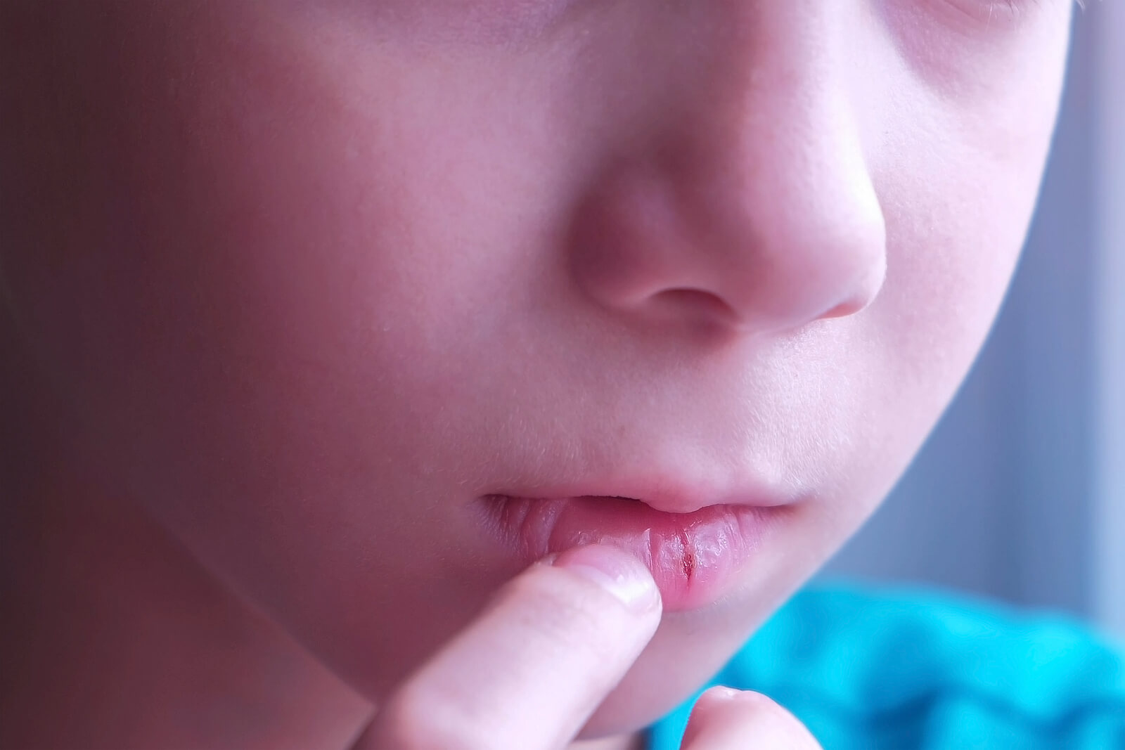 Niño con los labios agrietados.