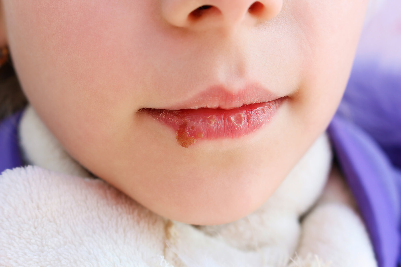 Candidiasis oral en niños síntomas, causas y tratamiento Eres Mamá