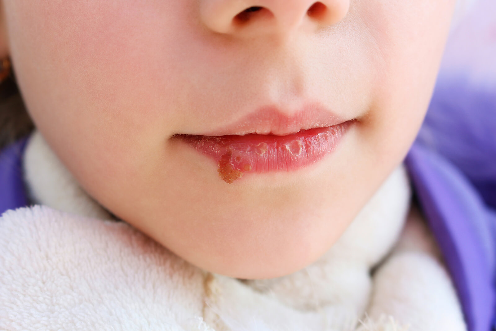Niño con candidiasis oral.
