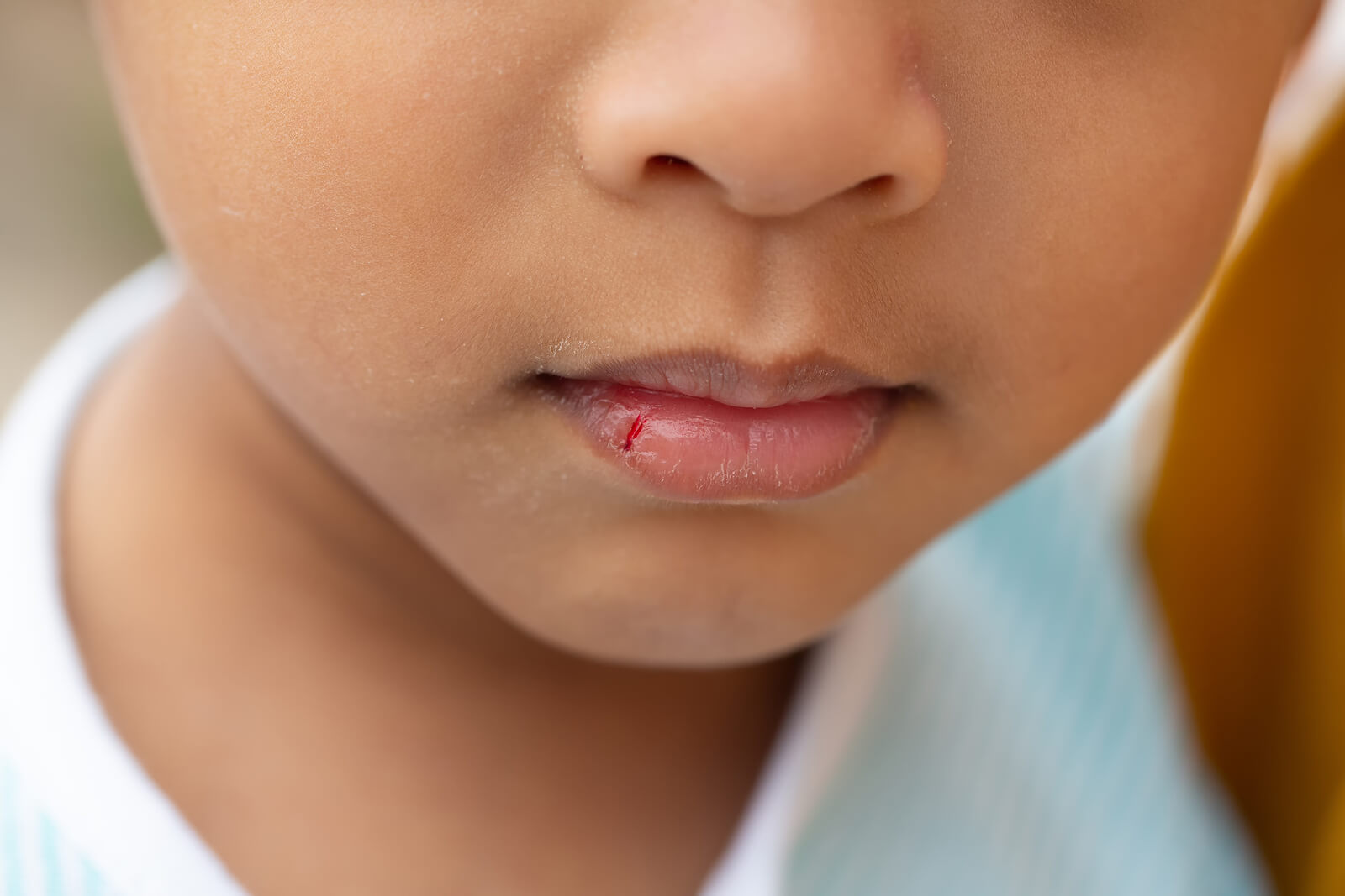 Rissige Lippen bei Kindern - Kind mit blutiger Lippe