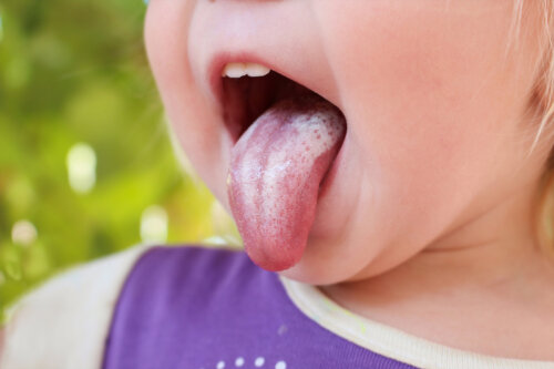 Lengua de un niño con candidiasis.