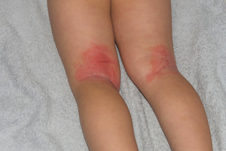 Eritrodermia en niños: síntomas, causas y tratamientos