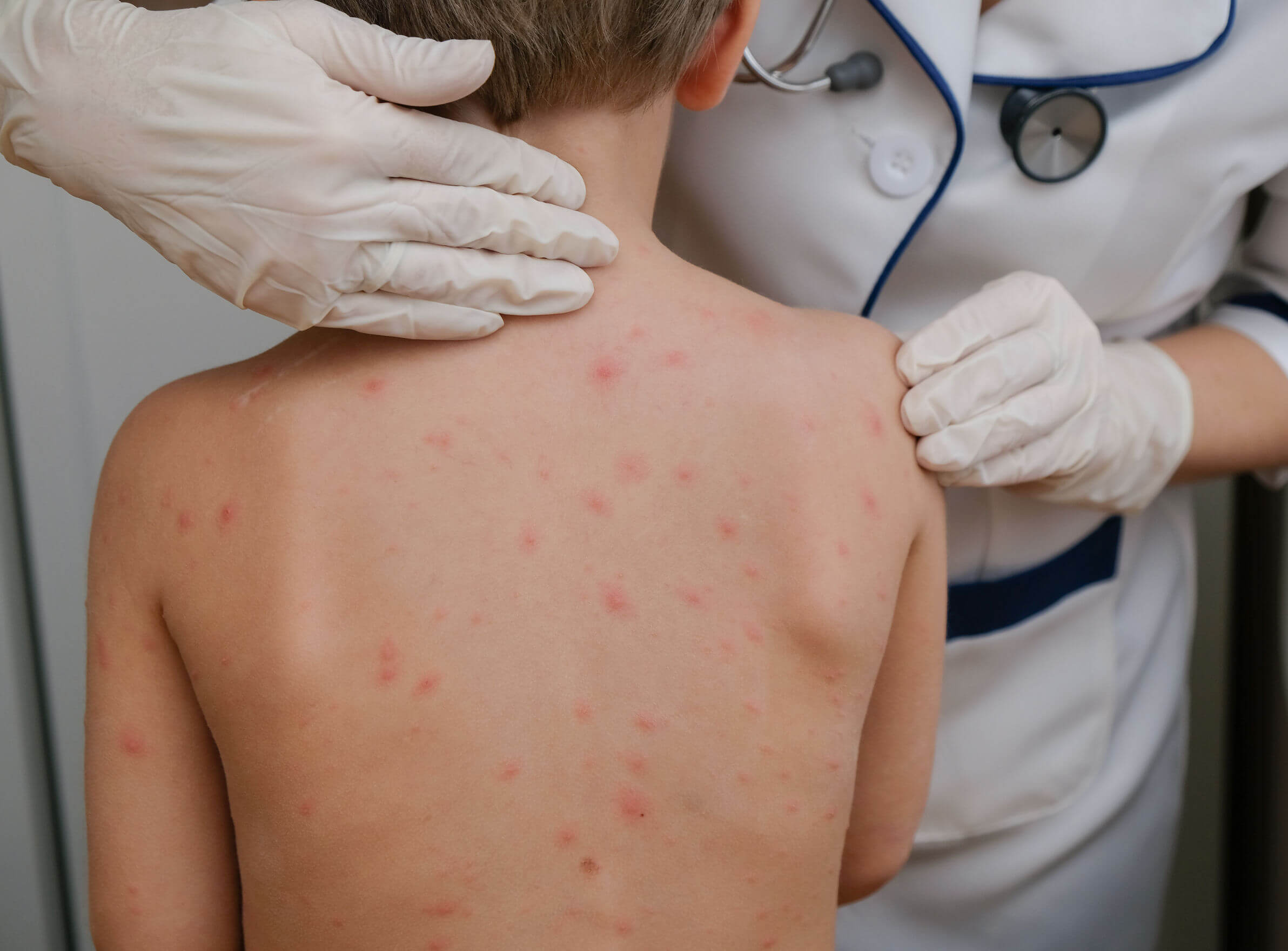 A child with a rash on his back being inspected by a doctor.