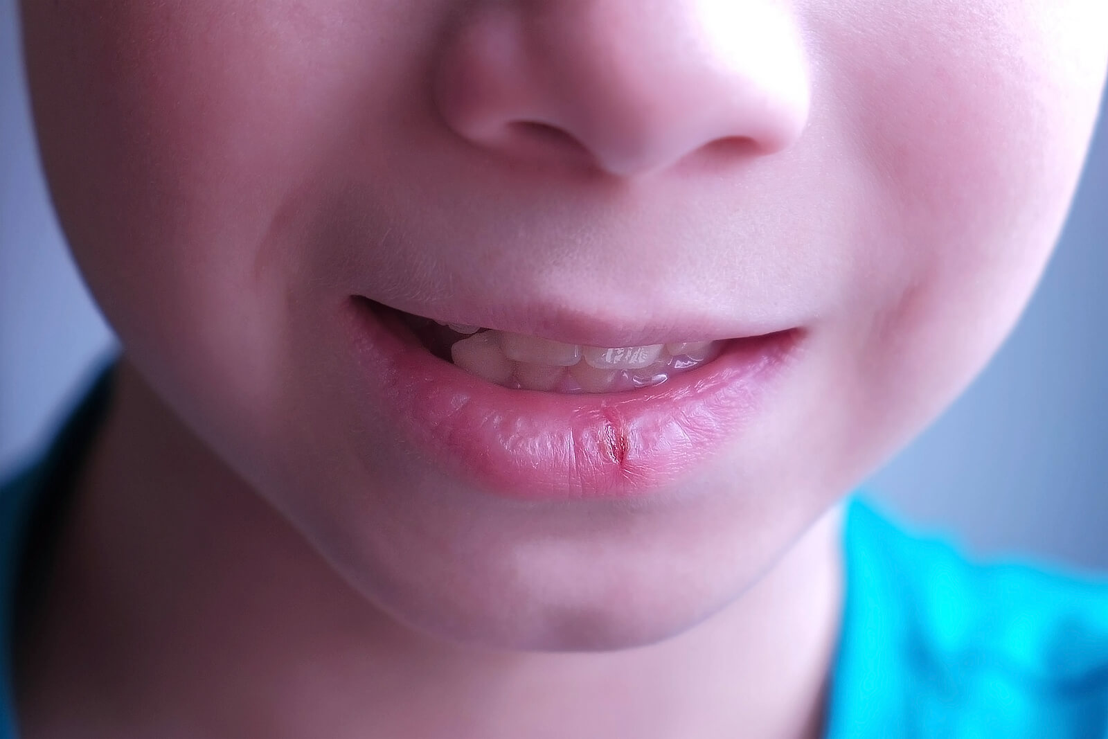 Labios agrietados en niños: causas y recomendaciones