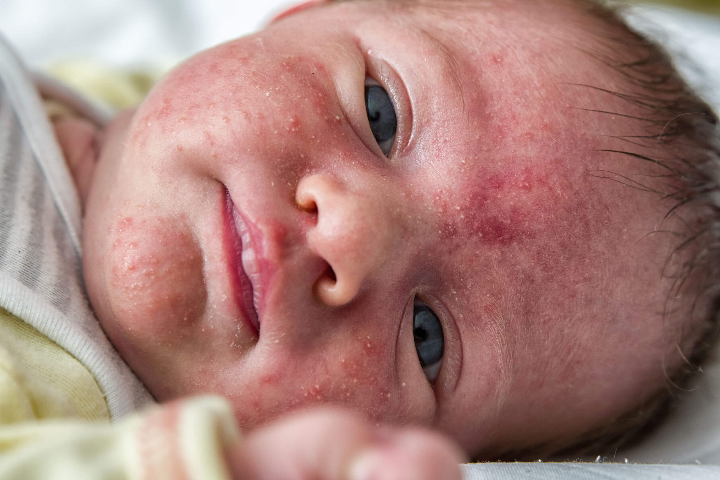 Bebé con acné neonatal.
