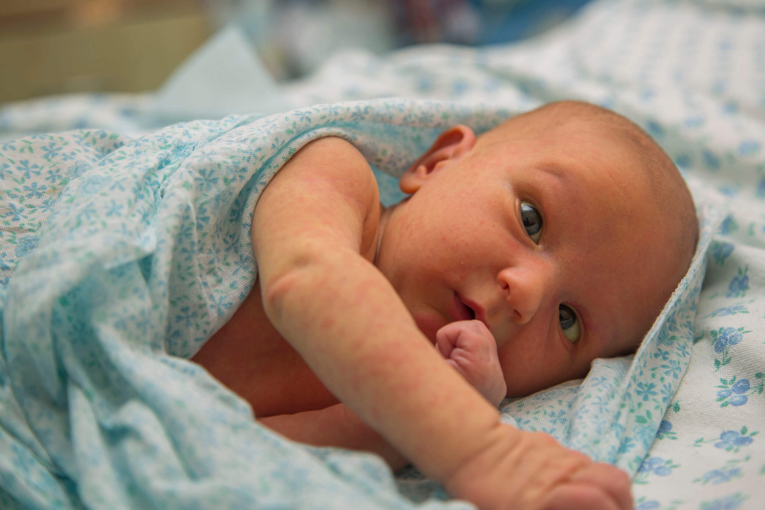 Recién nacido con granitos en la cara.