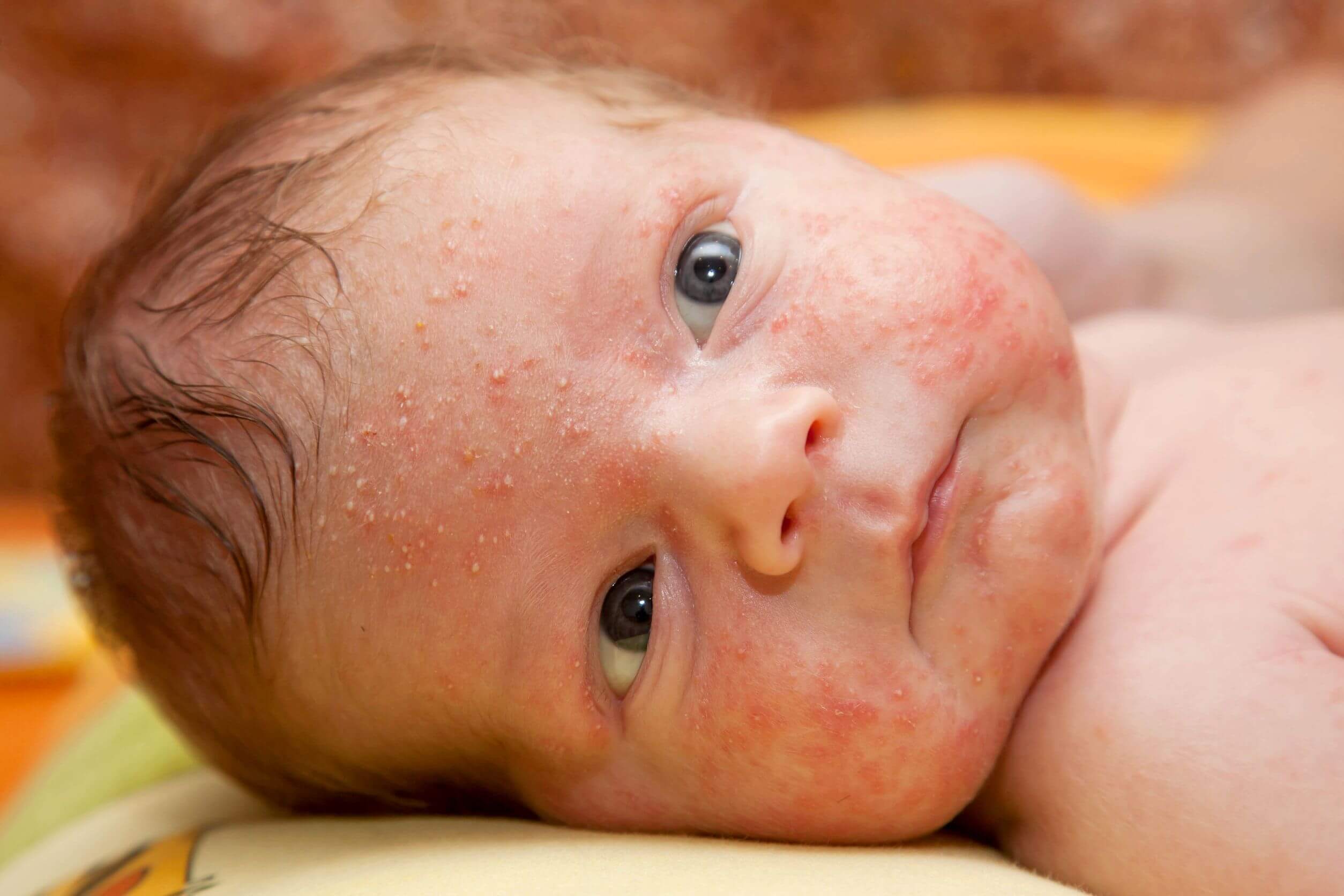 Recién nacido con acné neonatal.