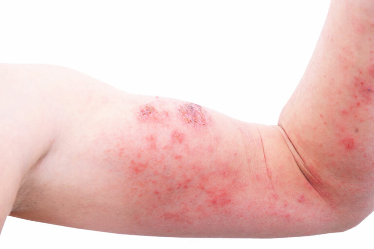 10 tipos de dermatitis en niños