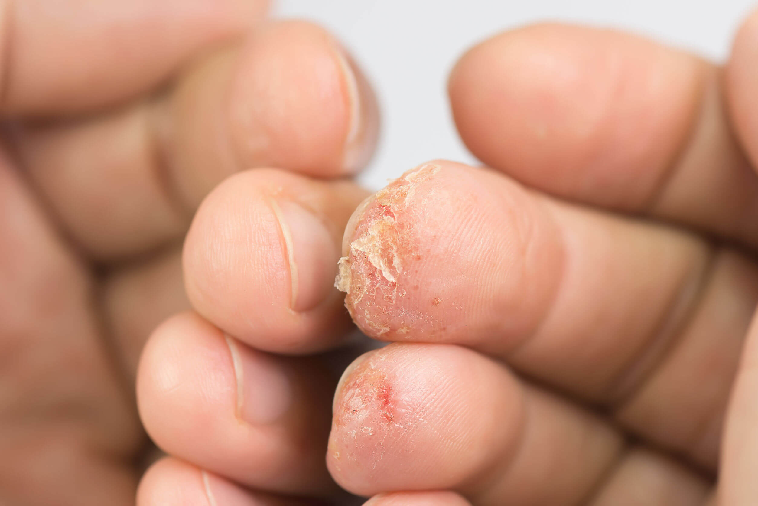 Dishidrosis en las manos.