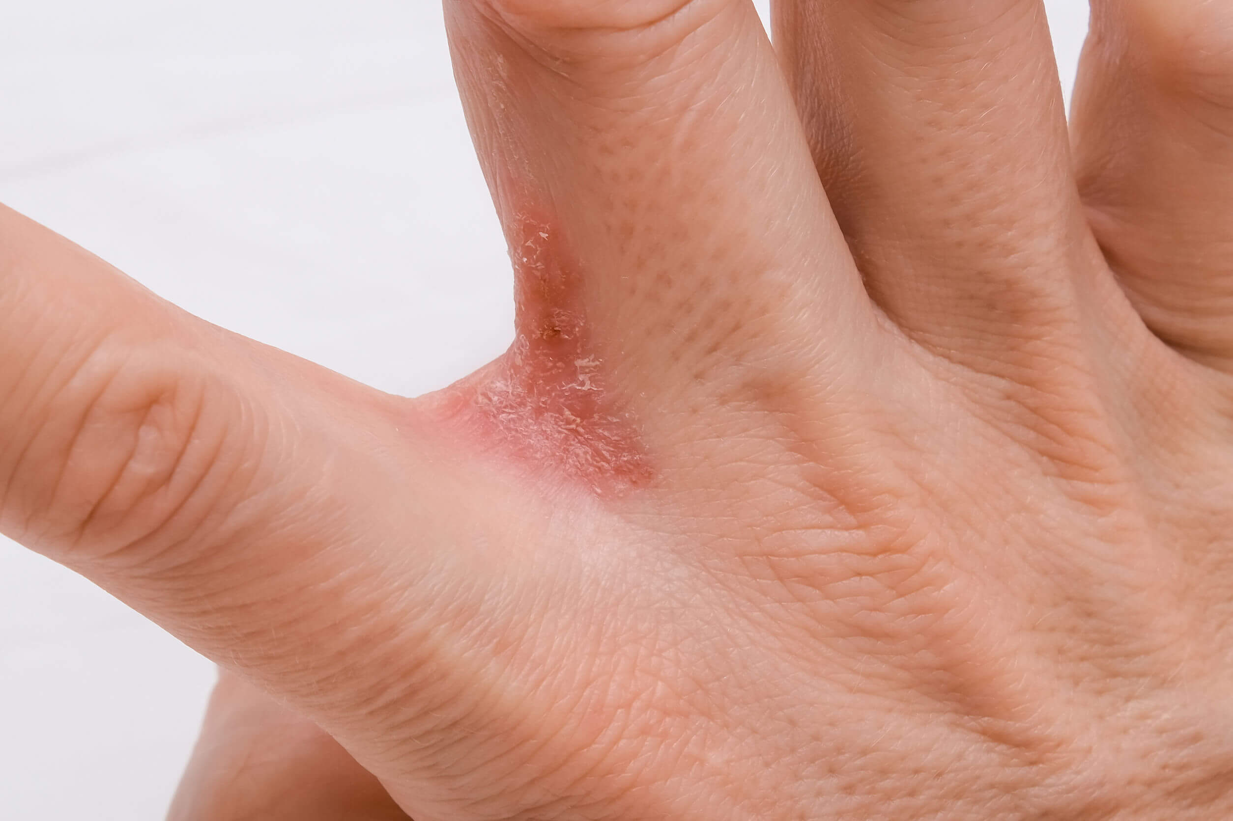Eczéma dyshidrotique sur les mains.