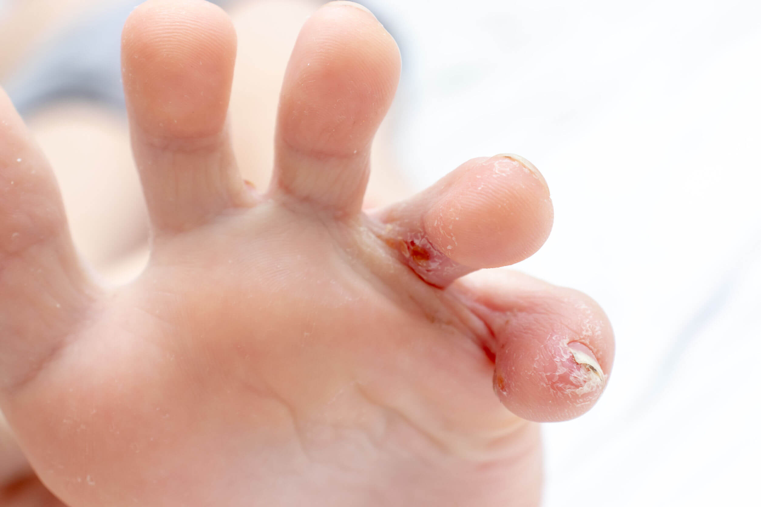 Dishidrosis en los pies.