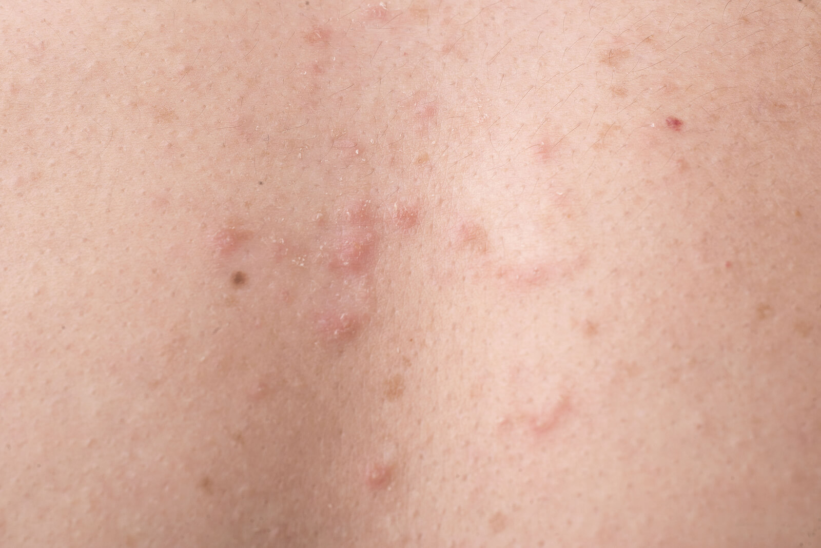 Espalda de un niño con pápulas.