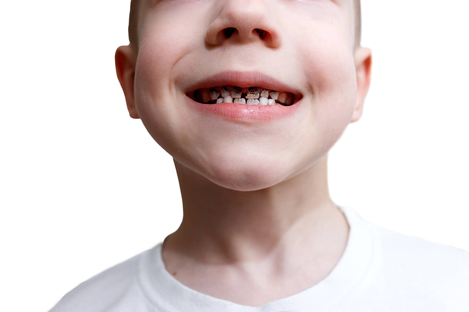 Niño con dientes negros por caries.