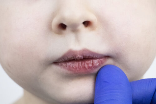 Niño con los labios secos y agrietados.