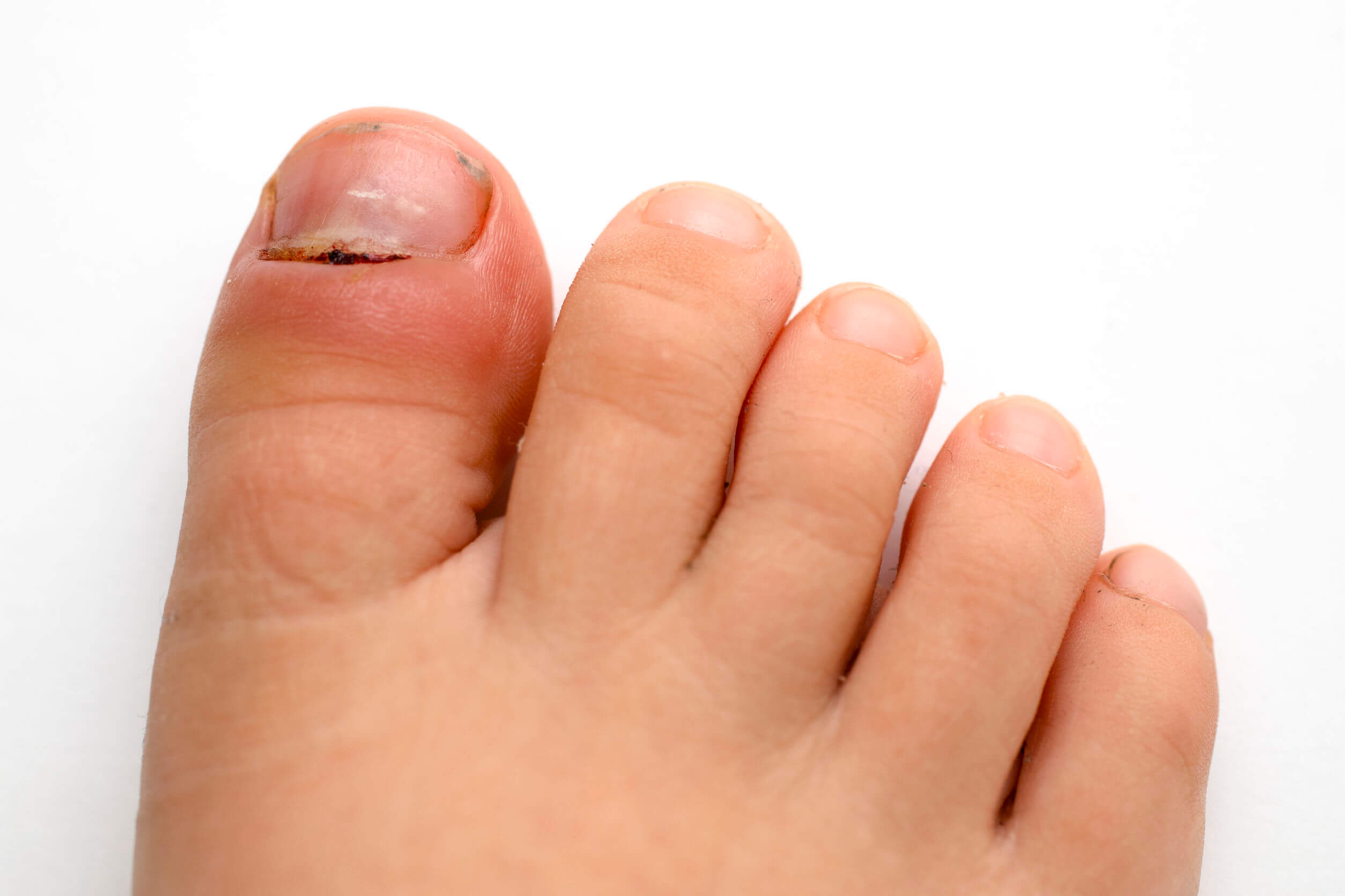 Paroniquia en niños: síntomas, causas y tratamiento