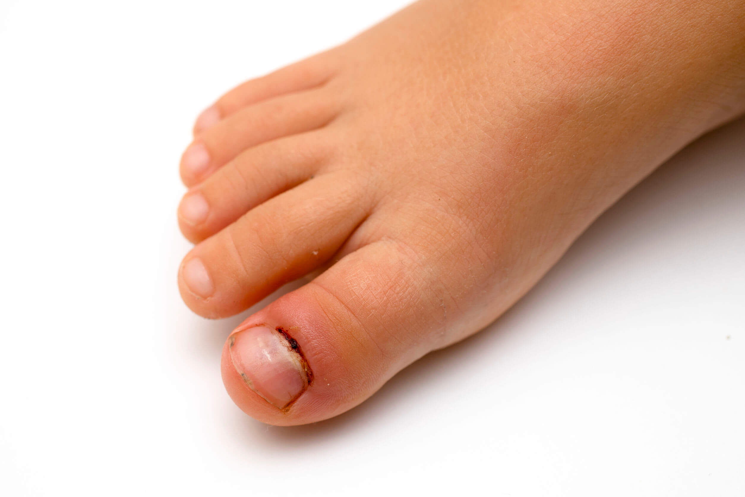 Paroniquia en niños.