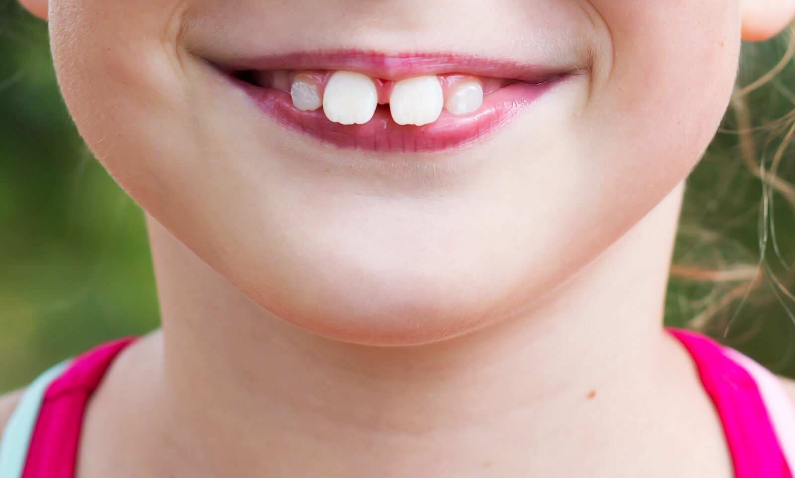 Boca de una niña con maloculsiones.