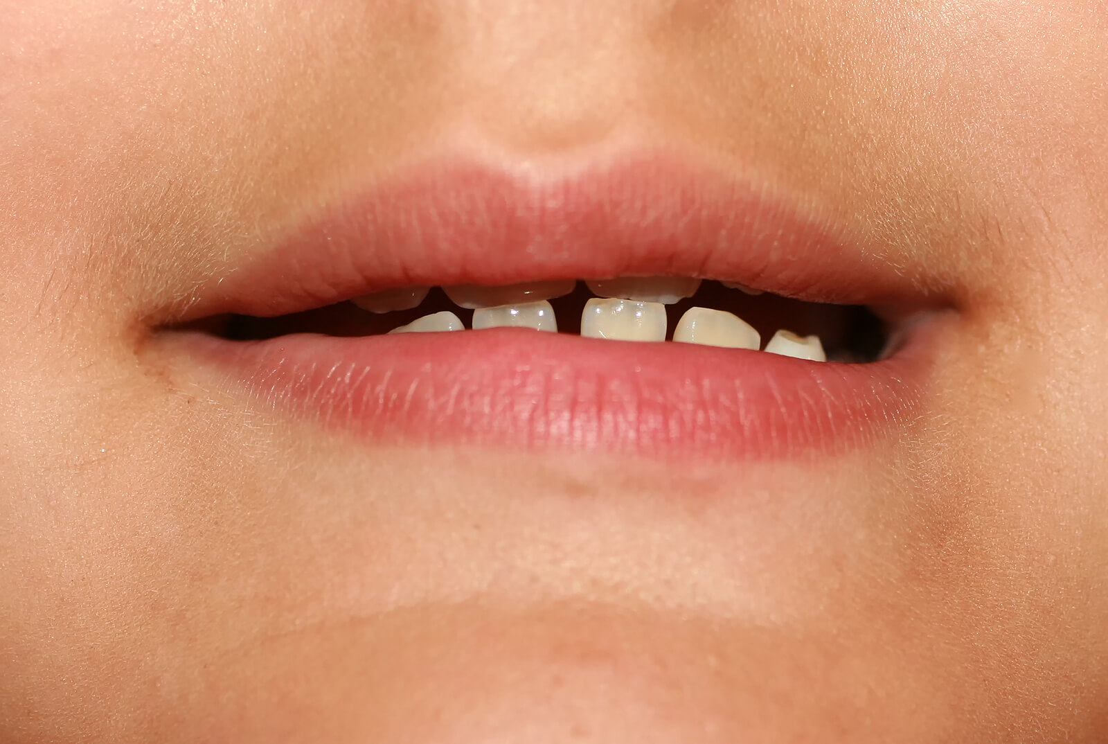 ¿Qué es la maloclusión en niños?