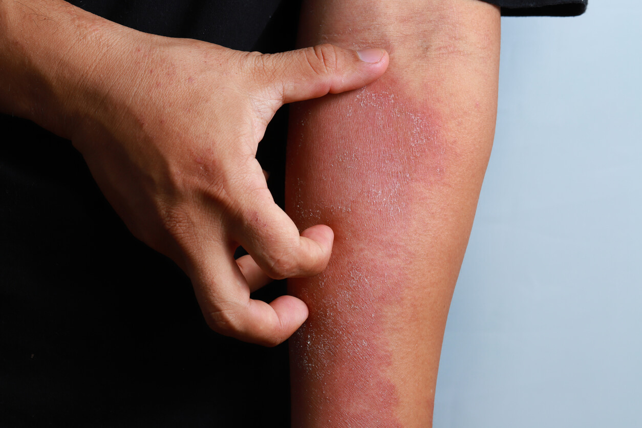 Dermatillomanie - eine Person kratzt sich die Haut wund