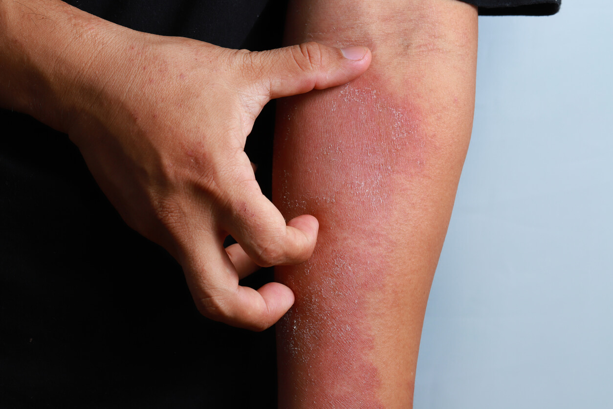 A person scratching a red patch of skin.