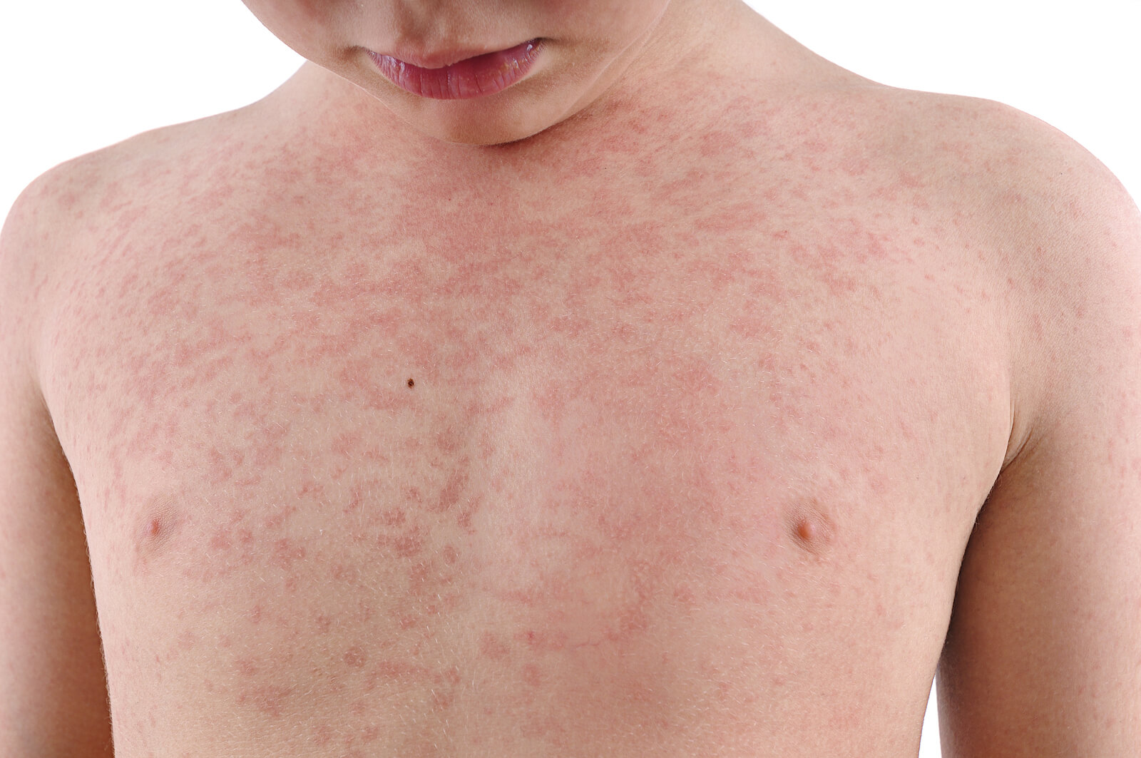 ¿Qué puede causar urticaria en niños?