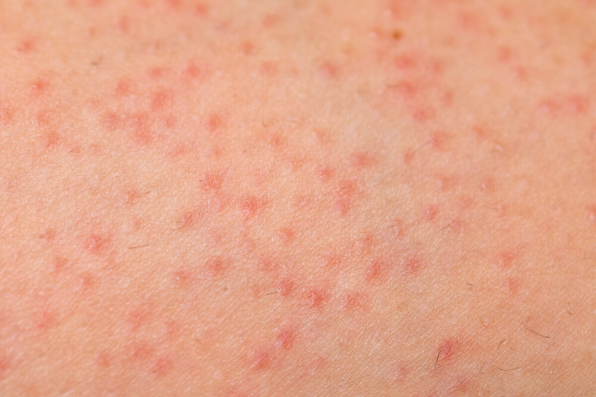 Queratosis pilaris.