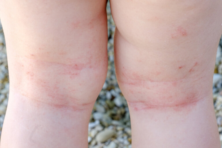 10 preguntas sobre la dermatitis atópica