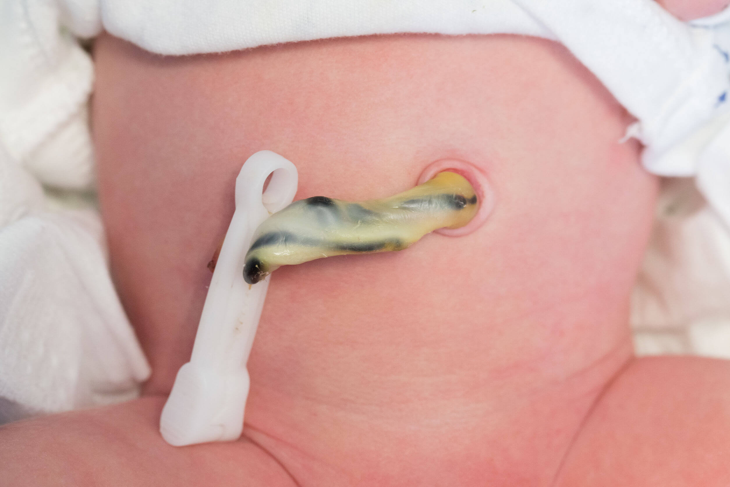 Nombril et cordon ombilical d'un nouveau-né.