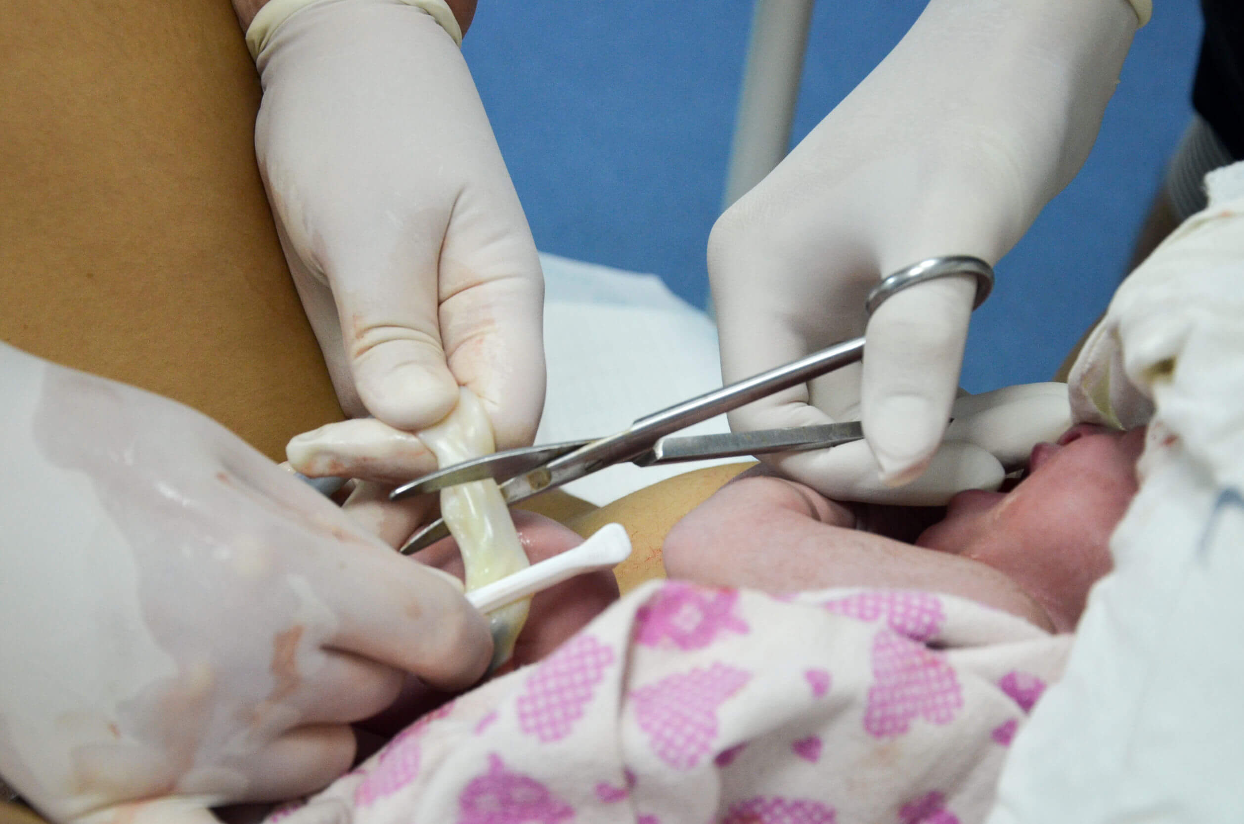 Doctors cutting the umbilical cord of a newborn.