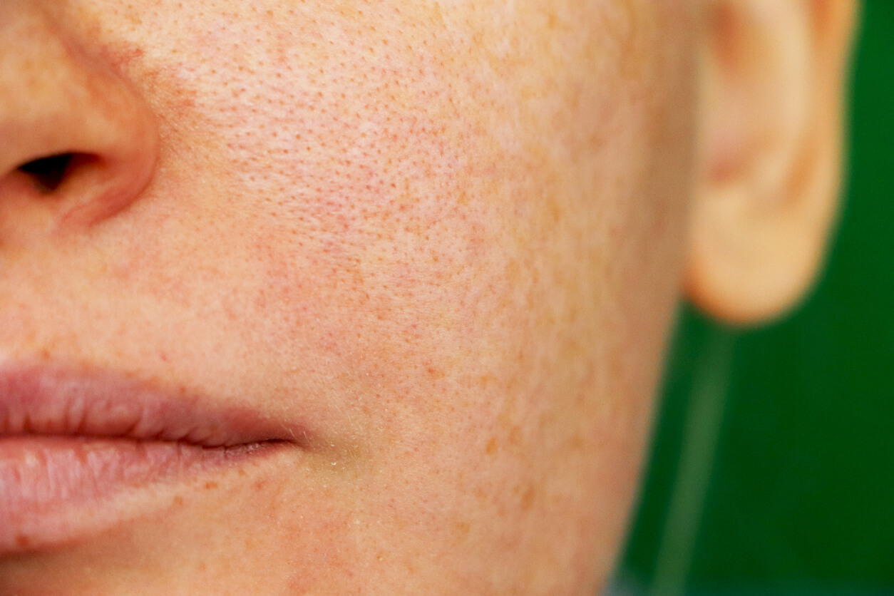 Femme avec mélasma sur son visage.
