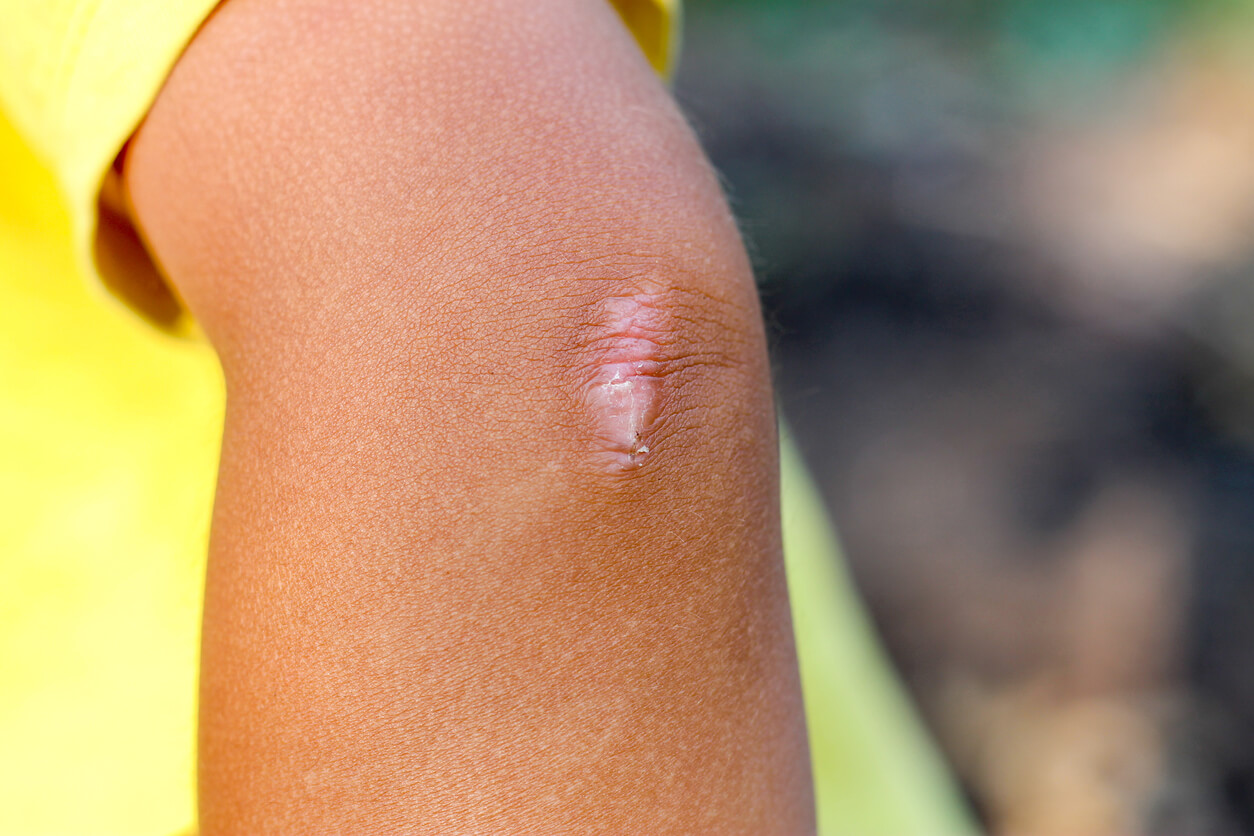 A scar on a child's elbow.