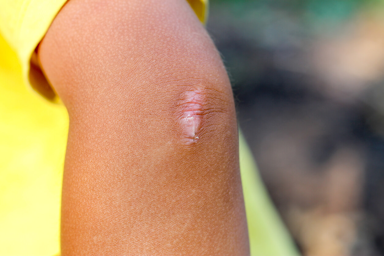 Cómo tratar las cicatrices en los niños