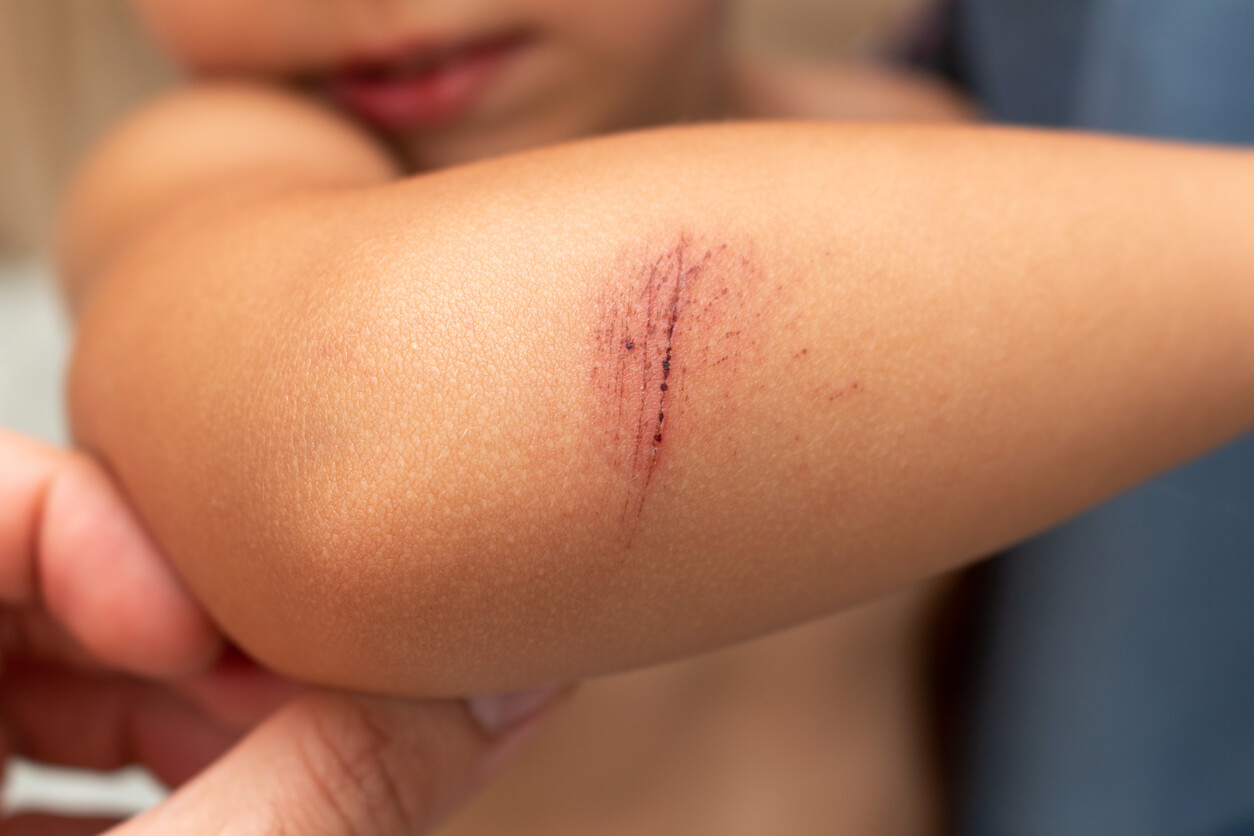 Niño con una herida en el brazo que le va a dejar cicatriz.