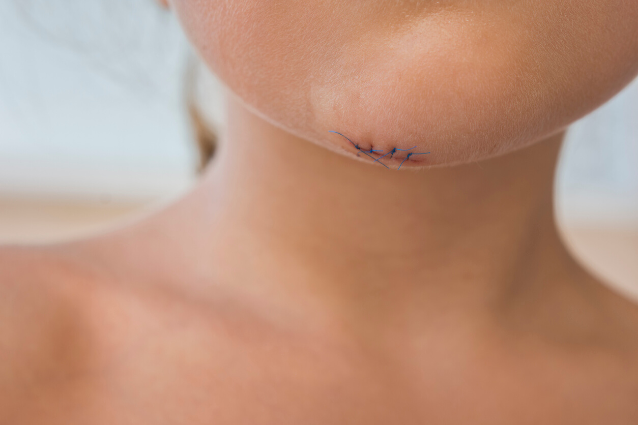 Enfant avec des points de suture sur le menton.