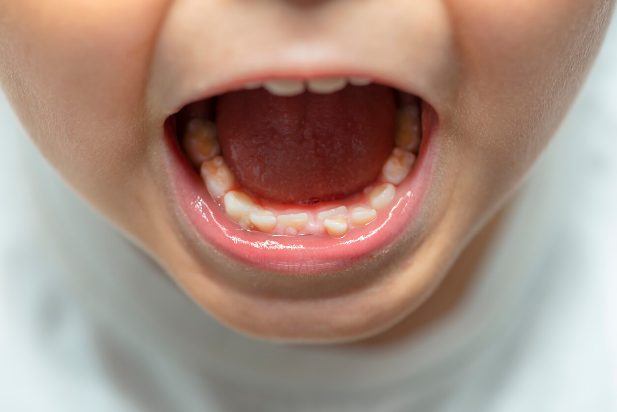 Boca de un niños con los dientes mal colocados.