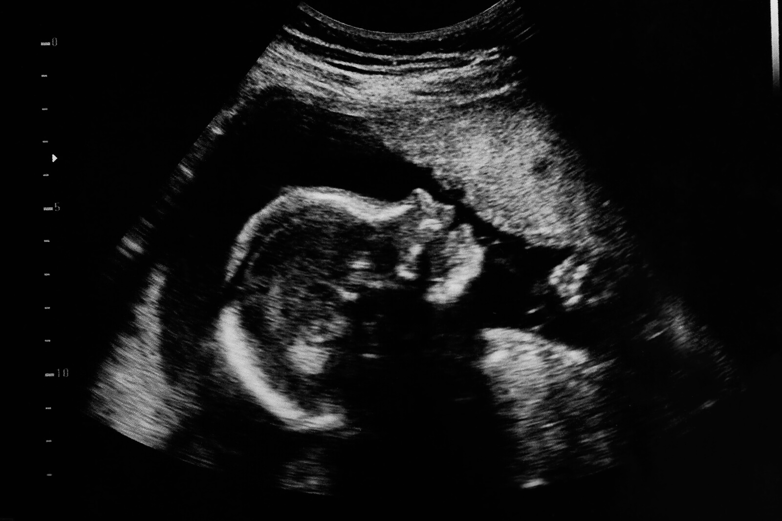 Echographie in utero.