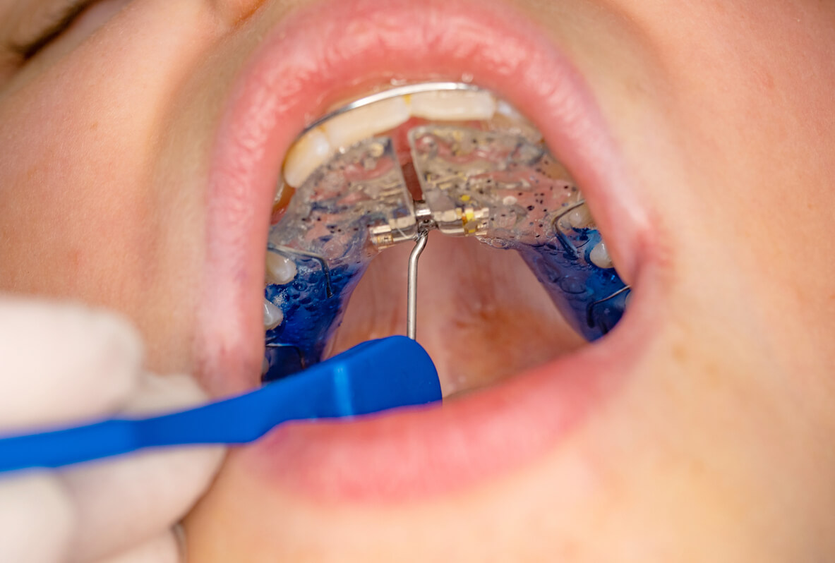 Paladar ojival o estrecho en niños: ¿hay que tratarlo?