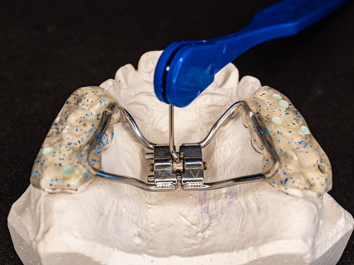 Ortodoncia interceptiva para el paladar ojival o estrecho.