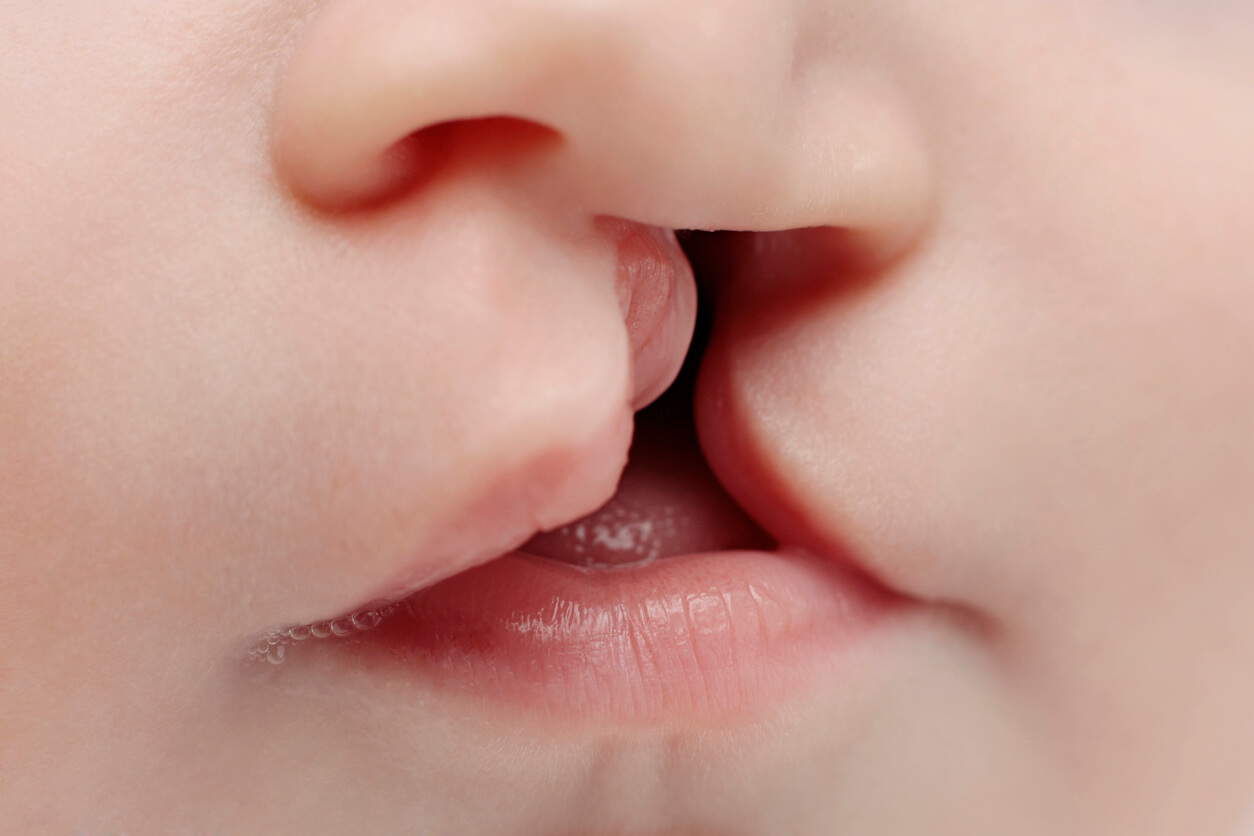 Bébé avec fente labiale.