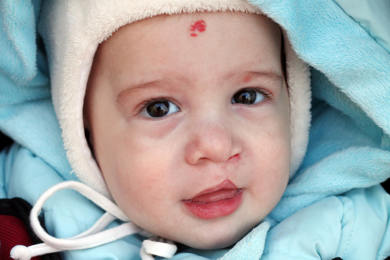 Niño con labio leporino.