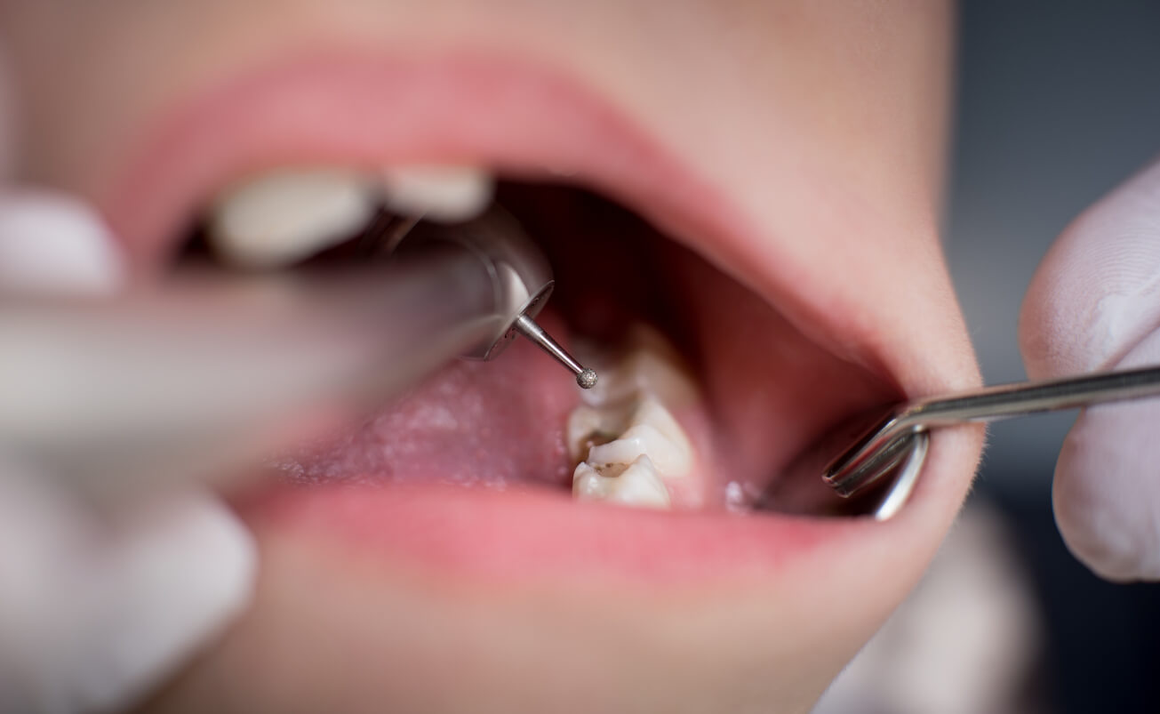 Enfant avec des caries chez le dentiste.