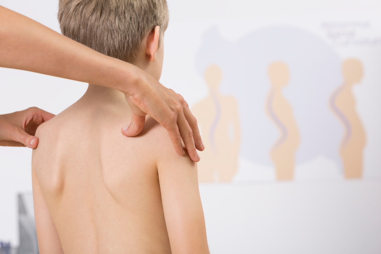 Enfant atteint de scoliose.