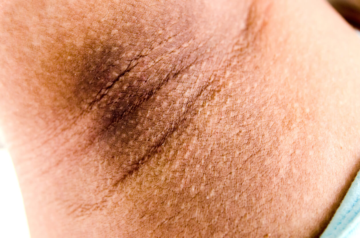 acantosis nigricans axila mujer obesidad resistencia insulina diabetes