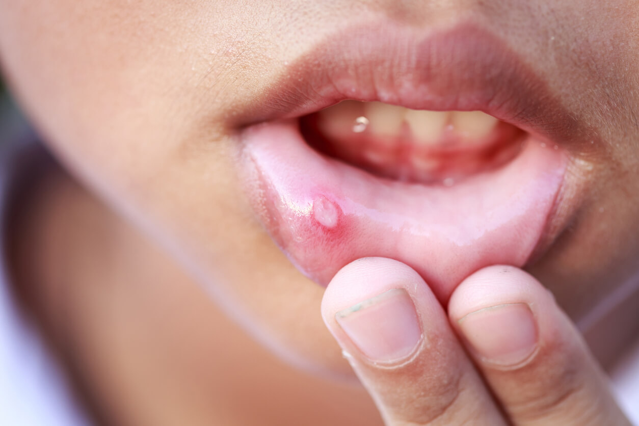 boca mucosa labio afta nino lesion oral