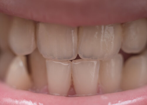 ¿El flúor puede decolorar los dientes de los niños?