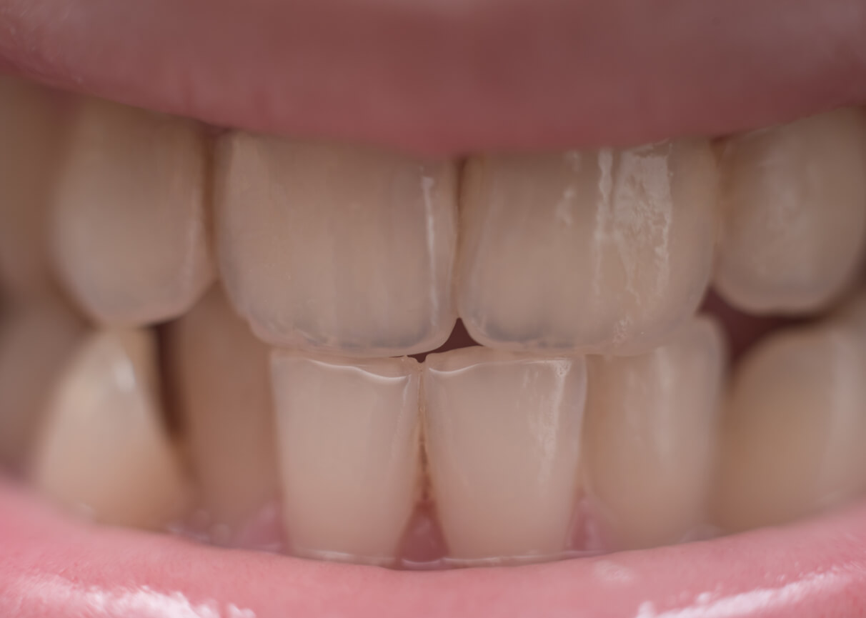 ¿El flúor puede decolorar los dientes de los niños?