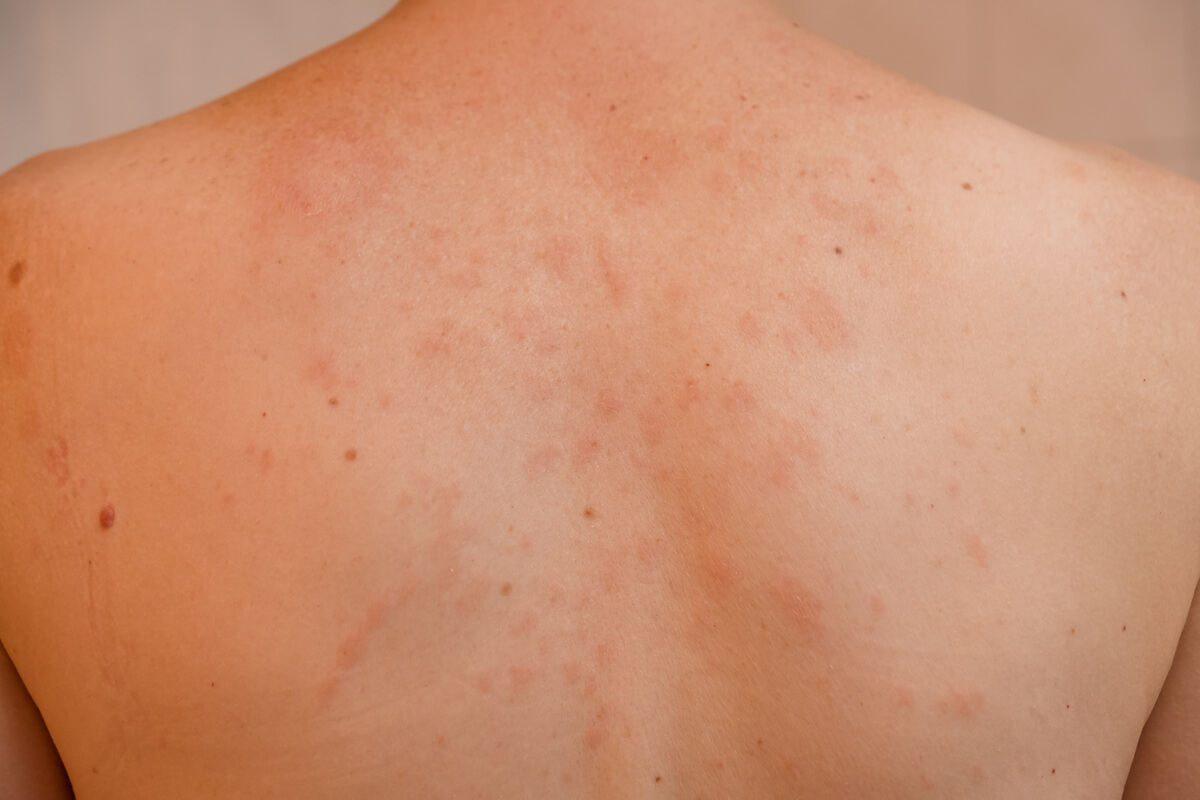 Dos d'un enfant atteint de pityriasis rosé.