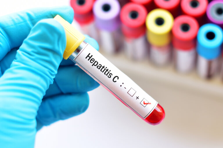Hepatitis C en el embarazo