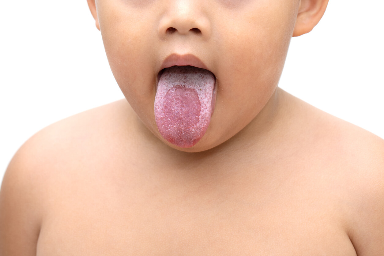 Een jongen met een witte tong